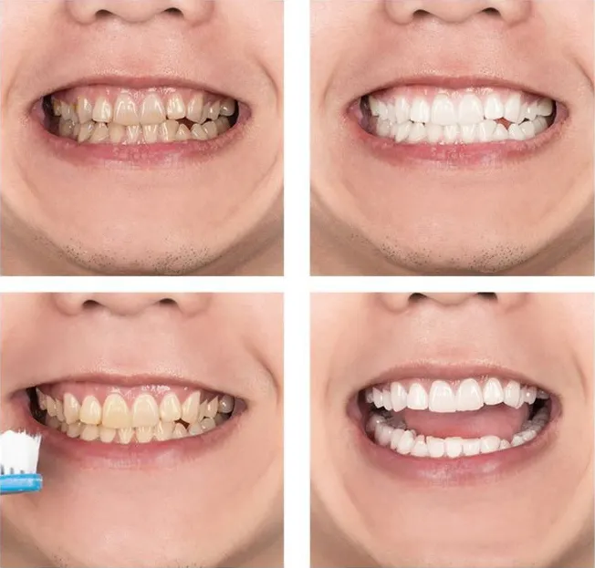 LANBENA Blue Tooth Whitening Agent