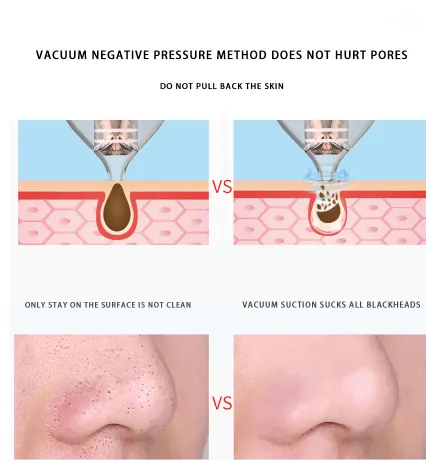 Blackhead suction artifact