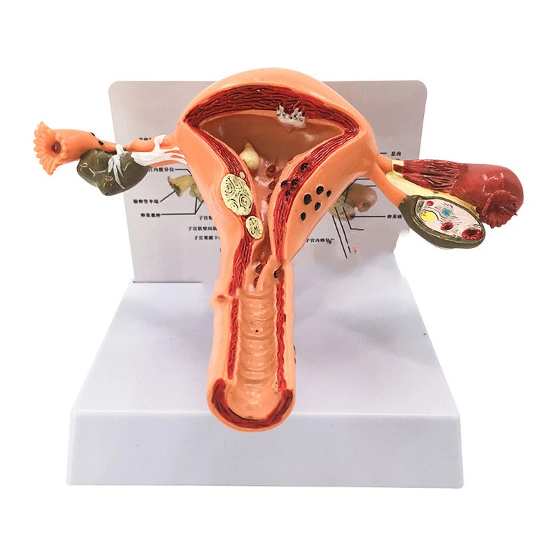 Female Pathological Uterus Model Female Maternal Uterus Structure Anatomy