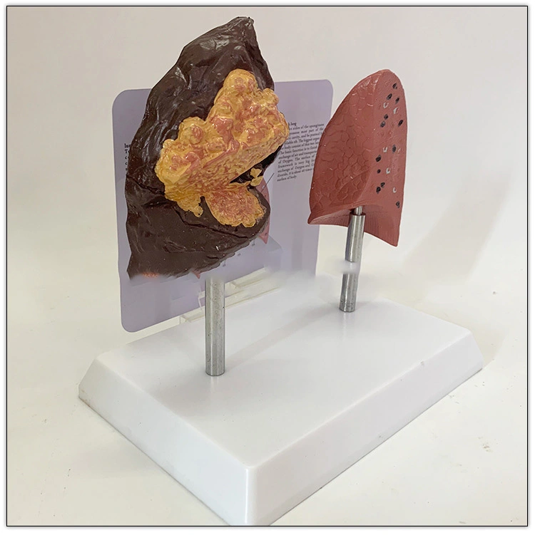 Comparison Model Of Human Smoking Lung And Healthy Lung