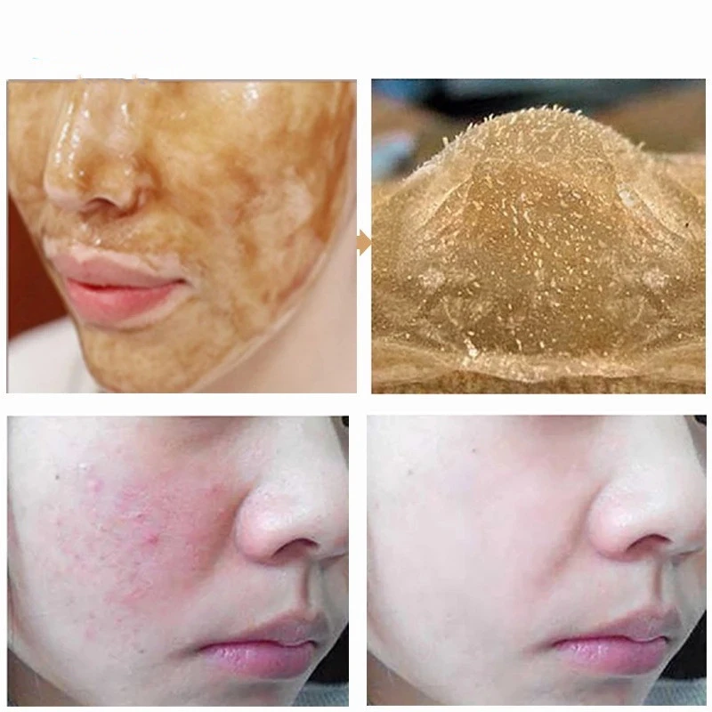 Tear Off The Mask To Cleanse Blackheads And Gently Soothe Delicate