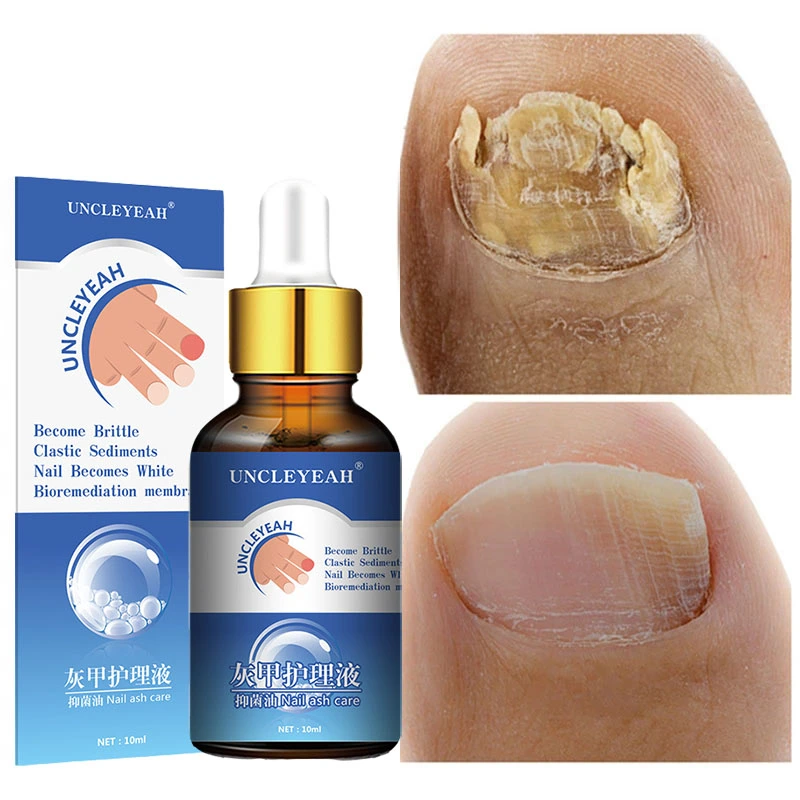 Onychomycosis Care Solution To Repair Hands And Feet