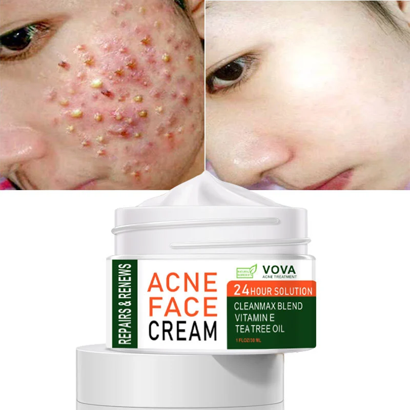 Acne Cream 30ml Is Easy To Use And Effective