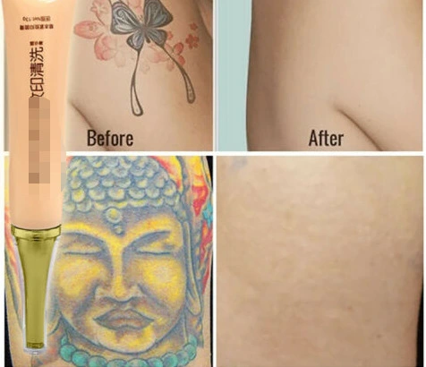 Tattoo Removal Cream