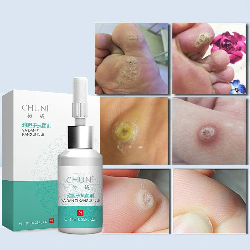 Antibacterial Agent Hands Feet And Corns