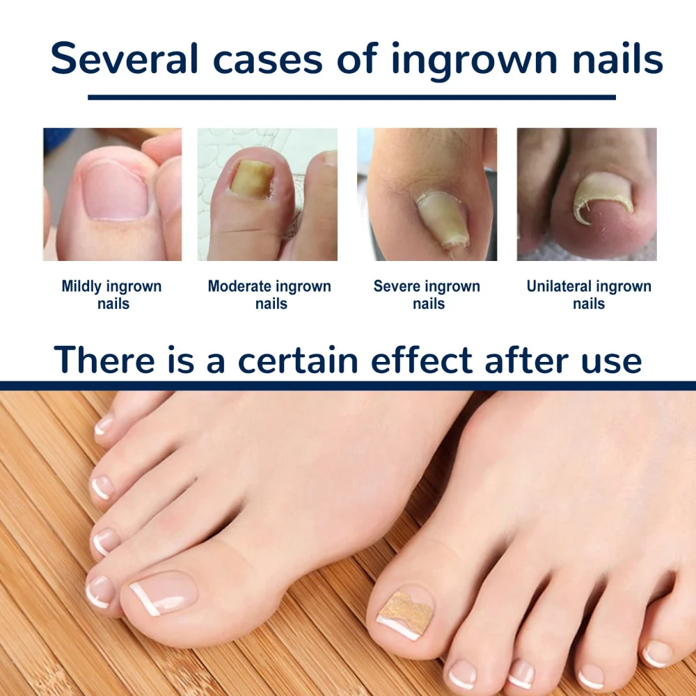 Toenail Corrective Patch Repair Embedded Nails