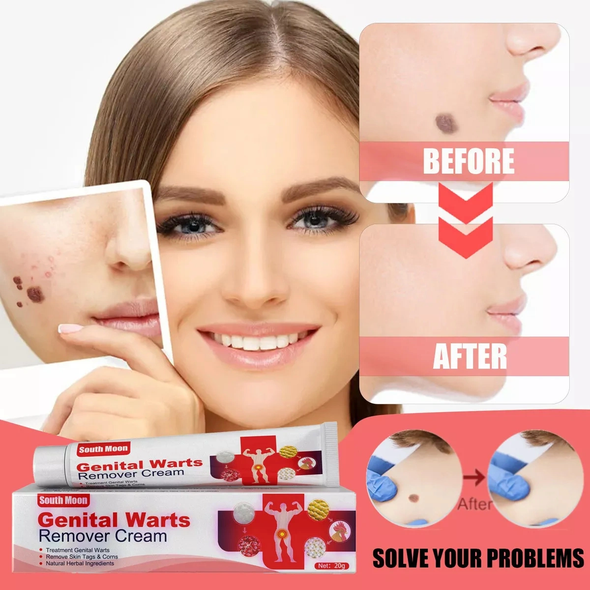 3PCS Skin Tag Removal Body Mole Wart Remover