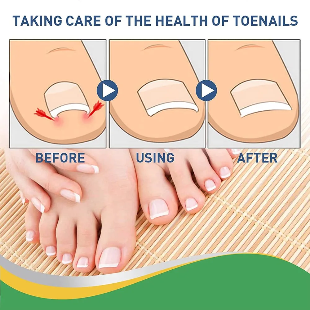 Fitmedify Nail Patches, Fit Medify Toenail Patches with Nail Correction Tool, Ingrown Toenail Corrector Strips, Correction Patches for Toe Nails Fungus, Relieve Nail Groove