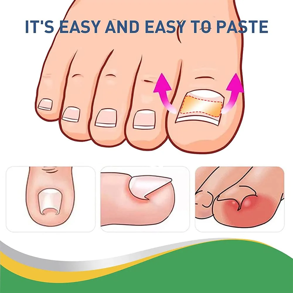 Ingrown Toenail Corrector,Fitmedify Nail Patches,Fit Toenail Patches,Ingrown Toenail Corrector Strips,Correction Patches for Toe Nails Fungus, Relieve Nail Groove