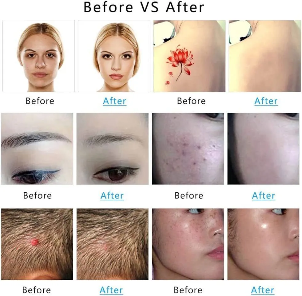 Tattoo Removal Pigment Prevention Spot Pen
