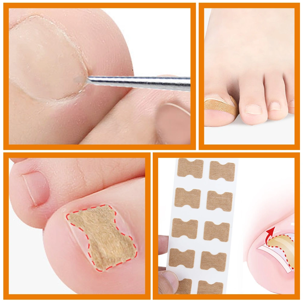 1 Set of Ingrown Toenail Patches and Nail Tool Toenail Correction Patches Toenail Stickers for Women