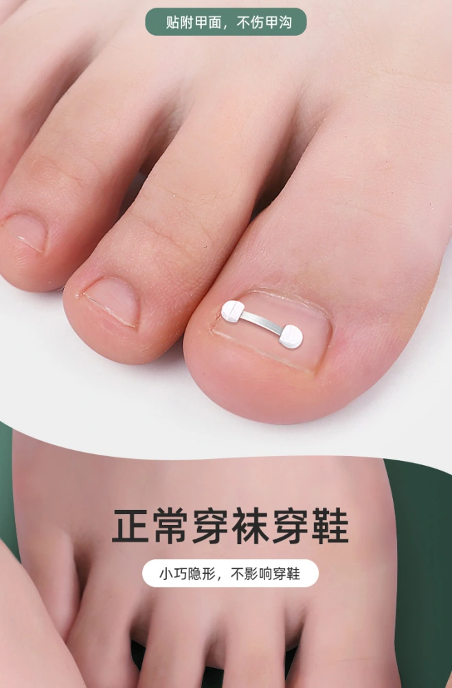 1 Sheet of Adhesive Toenail Strip Toenail Patch Ingrown Toenail Corrector Sticker Toenail Patch