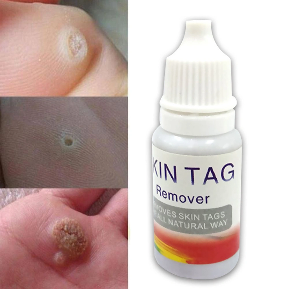 10ml Skin Tags Remover Natural Foot Corn Plantar Warts Treatment Solution Liquid