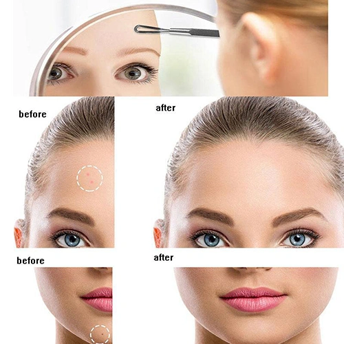 7 Pcs Stainless Steel Blackhead Pimple Acne Blemish Extractor Remover Tool Set