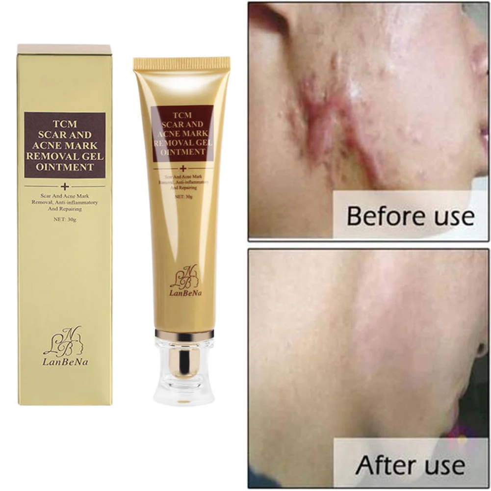 30g Scar Acne Mark Removal Wound Repair Skin Care Treatment Cream Ointment