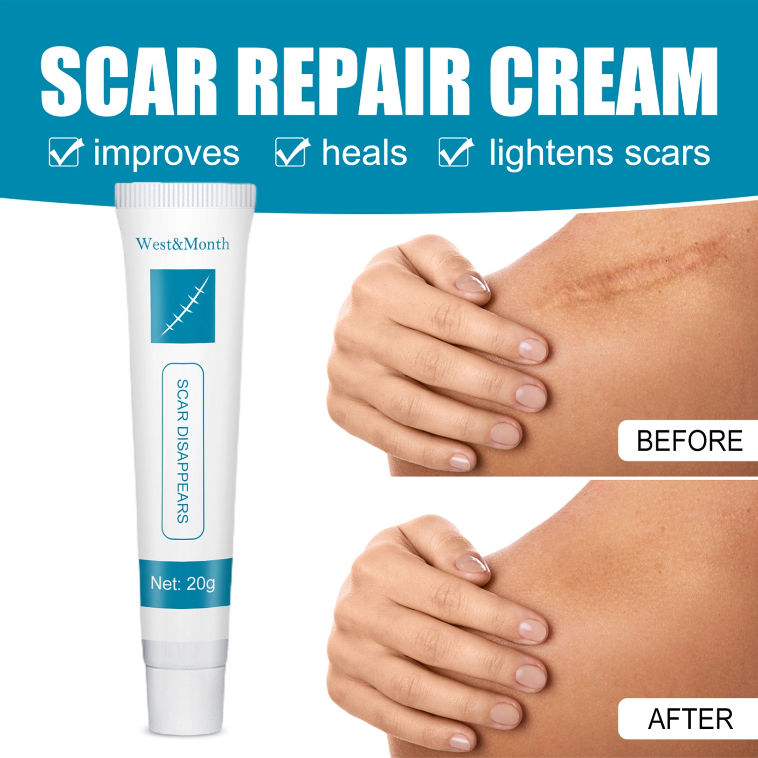 20g Acne Mark Ointment Effective Lightweight Convenient Acne Scar Removal Skin Repair Cream for Beauty