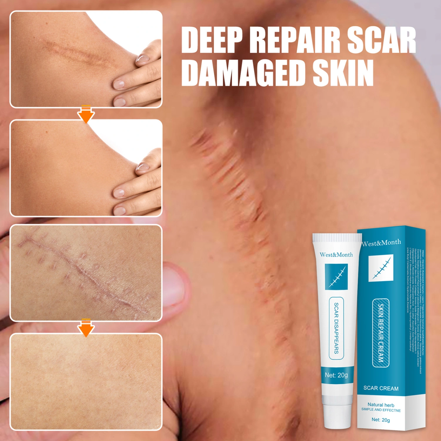 20g Acne Mark Ointment Effective Lightweight Convenient Acne Scar Removal Skin Repair Cream for Beauty