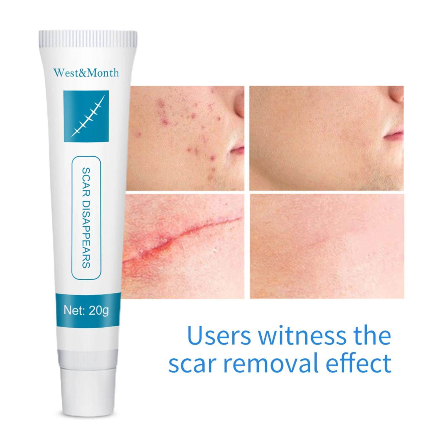 20g Acne Mark Ointment Effective Lightweight Convenient Acne Scar Removal Skin Repair Cream for Beauty