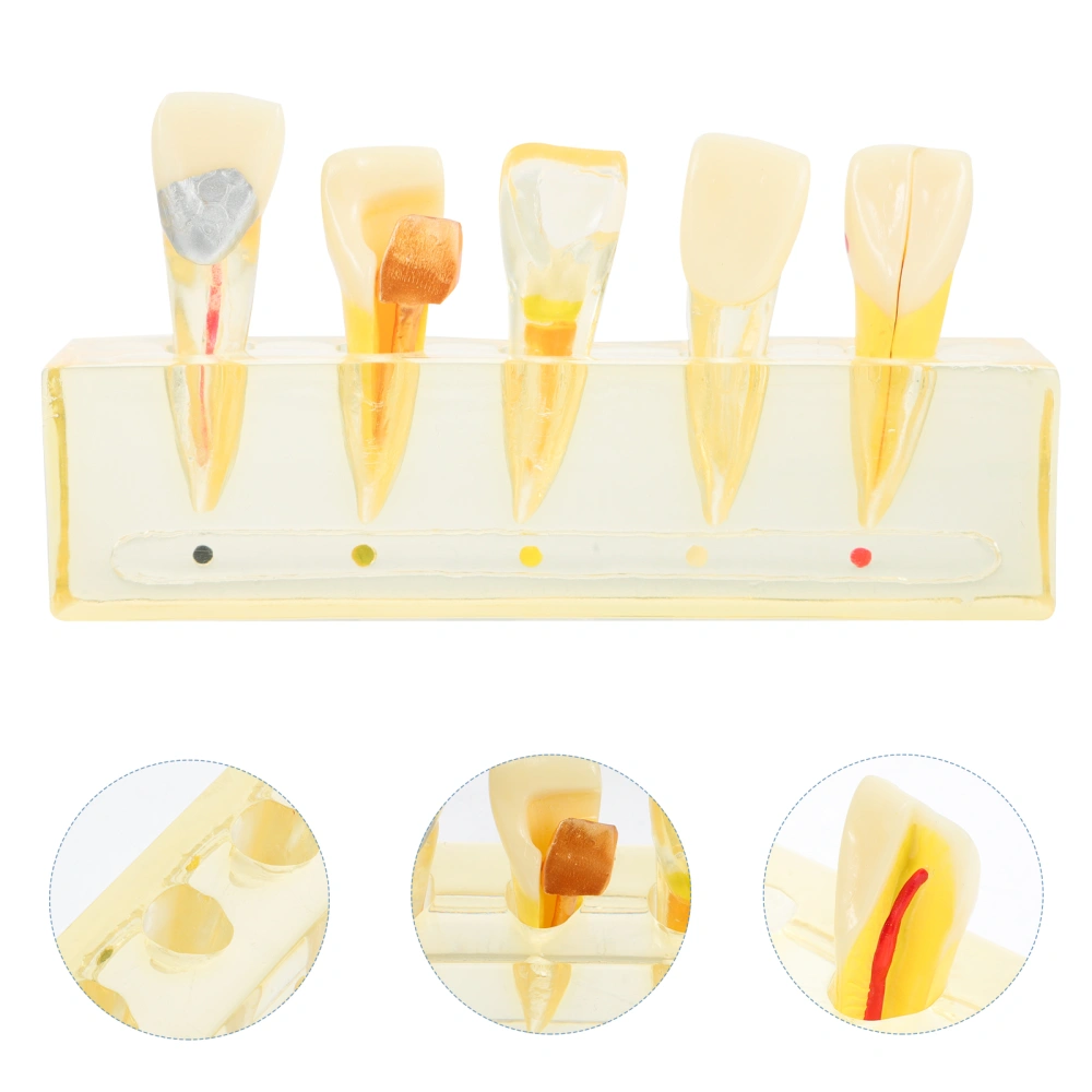 Front Teeth Endodontic Pathological Model Dental Pathological Model for Display