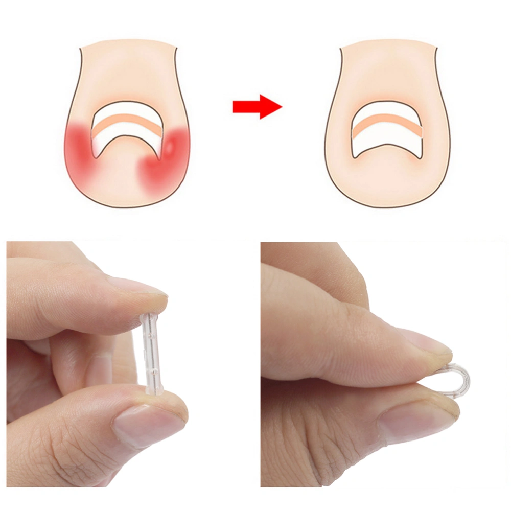 10Pcs Household Toenail Correctors Reusable Nail Treatment Professional Toenail Treatment