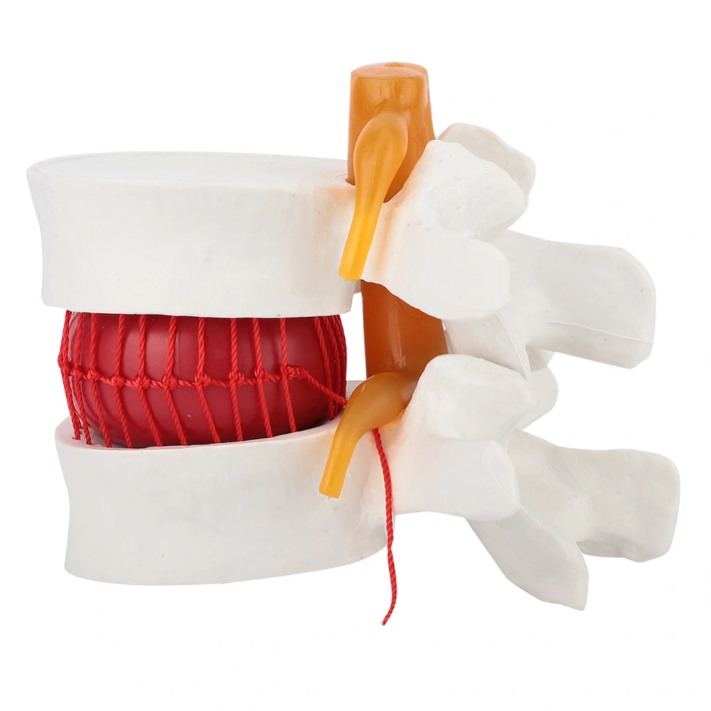 1:1.5 Medical Demonstration Model Of Lumbar Vertebral Spine Human Lumbar Disc Herniation Model