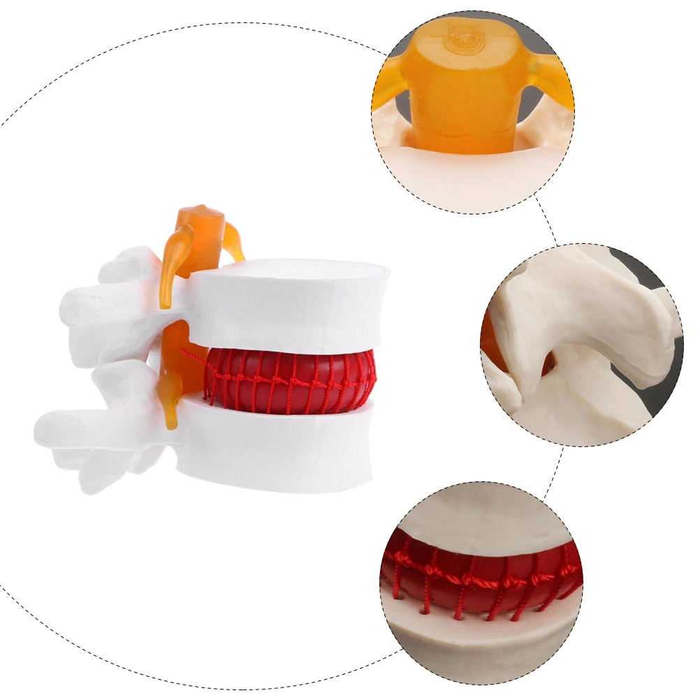 1pc Human Spine Model Lumbar Disc Herniation Presentation Model for School