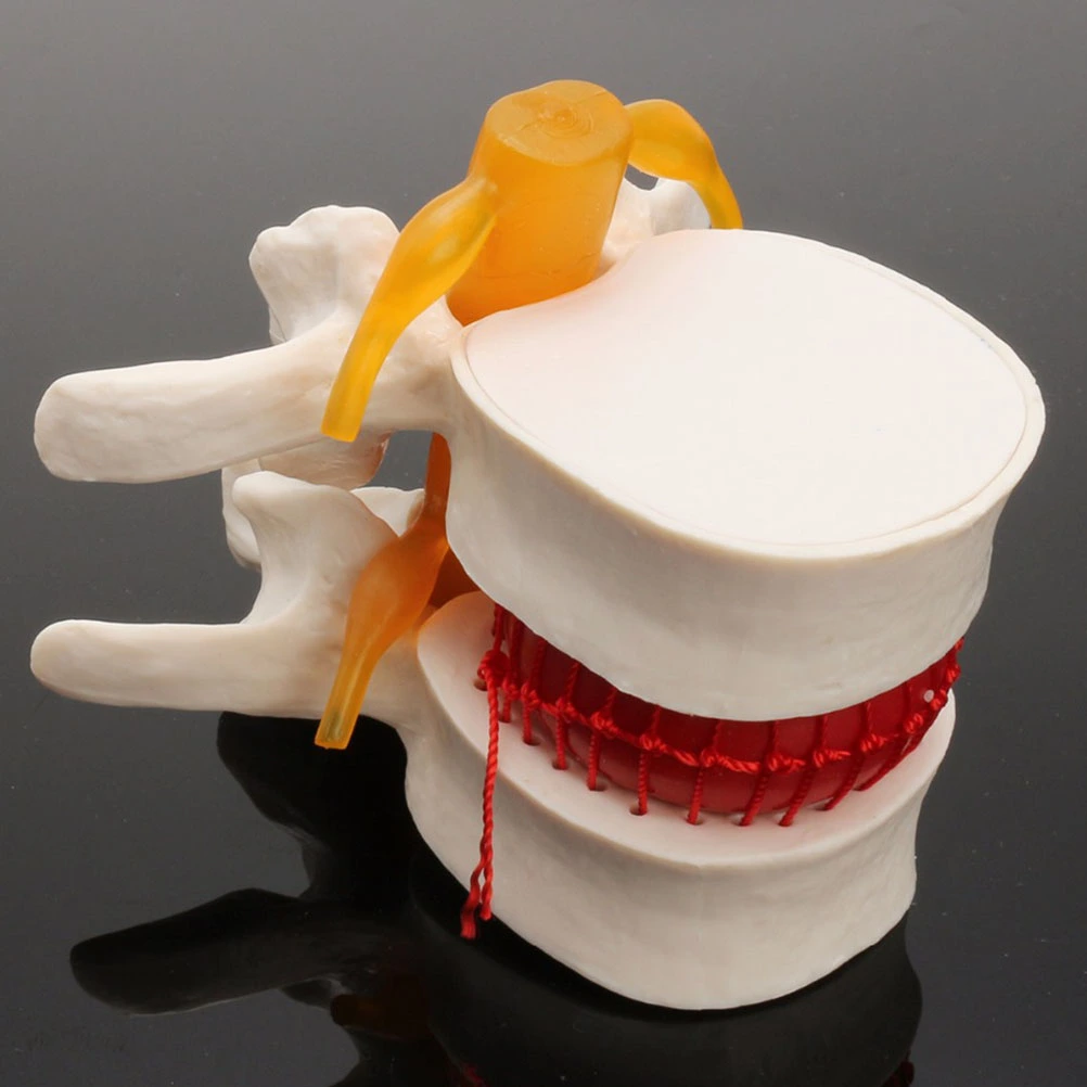 1pc Human Spine Model Lumbar Disc Herniation Presentation Model for School