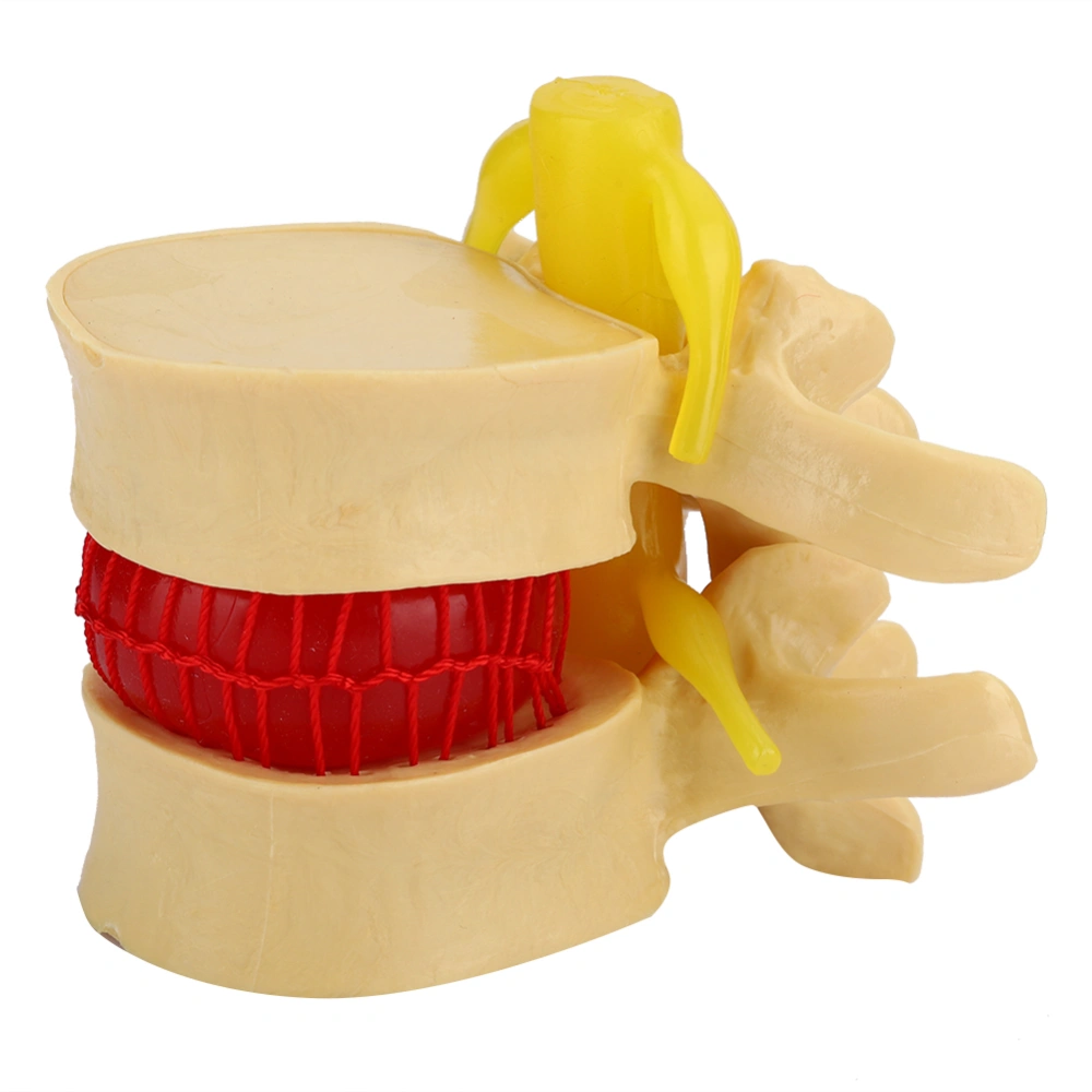 1:1.5 Lumbar Disc Herniation Demonstration Model Study Learn Human Spine