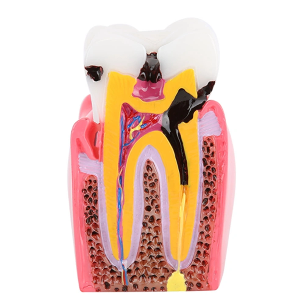 Caries Comparison Study Models Dentist Dental Anatomy Education Teeth Model