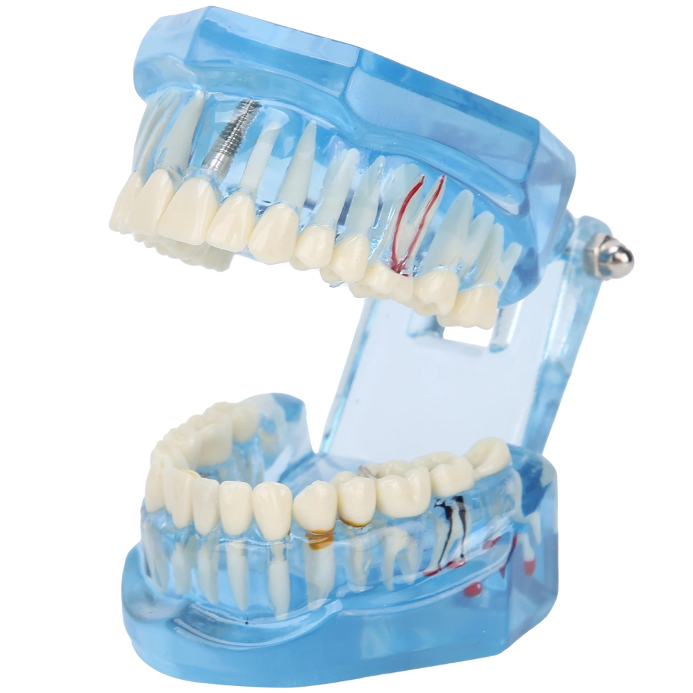 Dental Teeth Model Acrylic Blue Transparent Teaching Demonstration Simulation Teeth Model