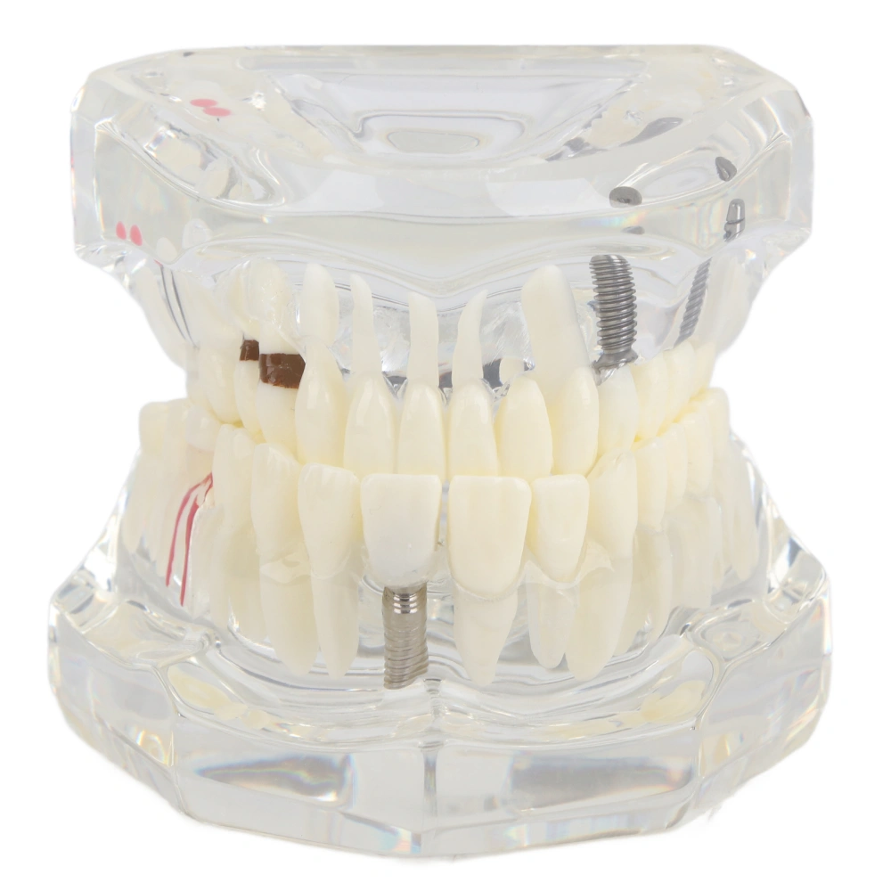 Dental Study Transparent Teeth Model Dental Laboratories Learning Teaching Teeth Model