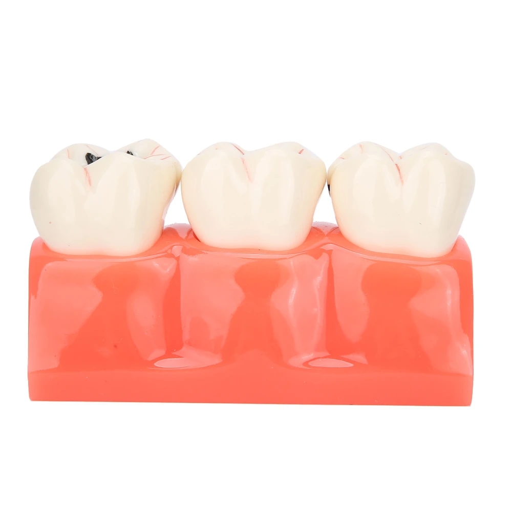 Dental Caries Model Tooth Decay Demonstration Model Simulation Detachable Teeth Model