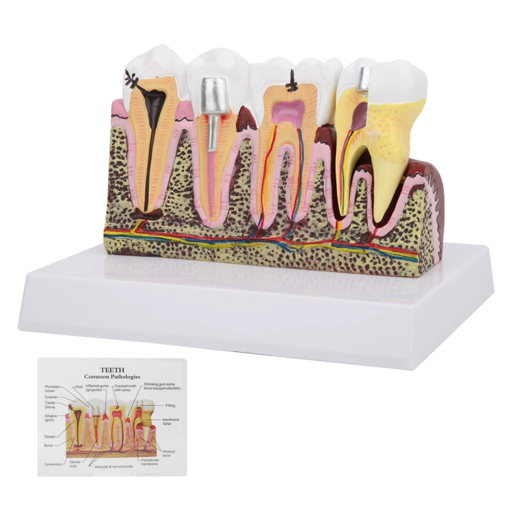 Dental Teeth Model Oral Cavity Detachable Anatomical Model Demonstration Base for Education