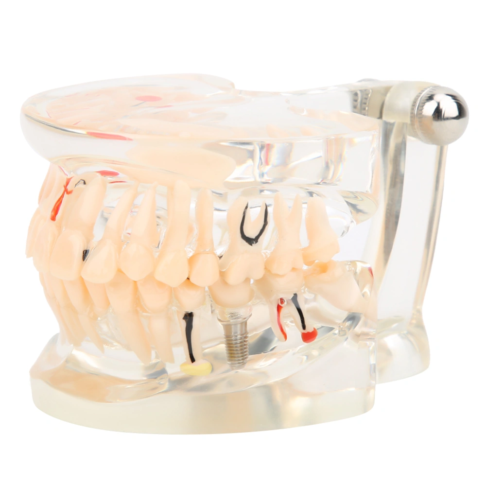 Adult Teeth Pathological Model Dental Implant Model Dental Study Teaching Teeth Model