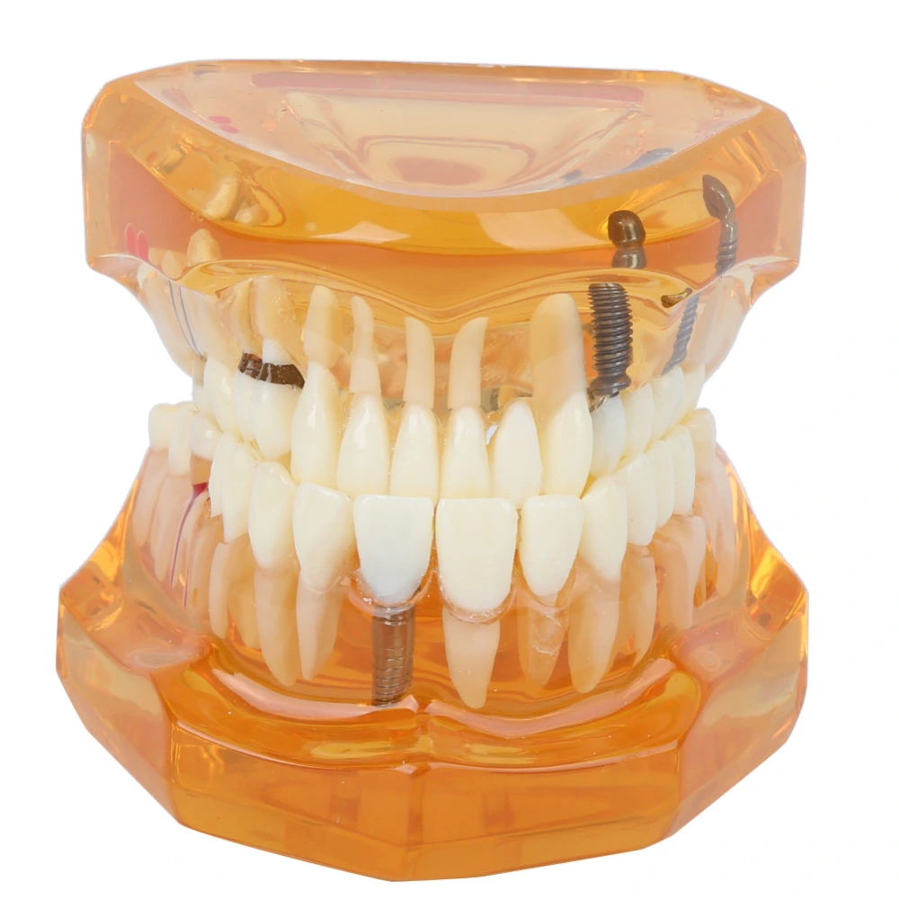 1pc Orange Color Dental Disease Removable Study Teaching Teeth Model