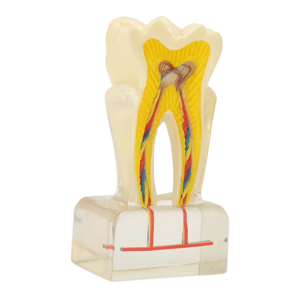 Dental Caries Model Acrylic 6 Times Decayed Tooth Model Dental Education Supplies for Dentists Teaching