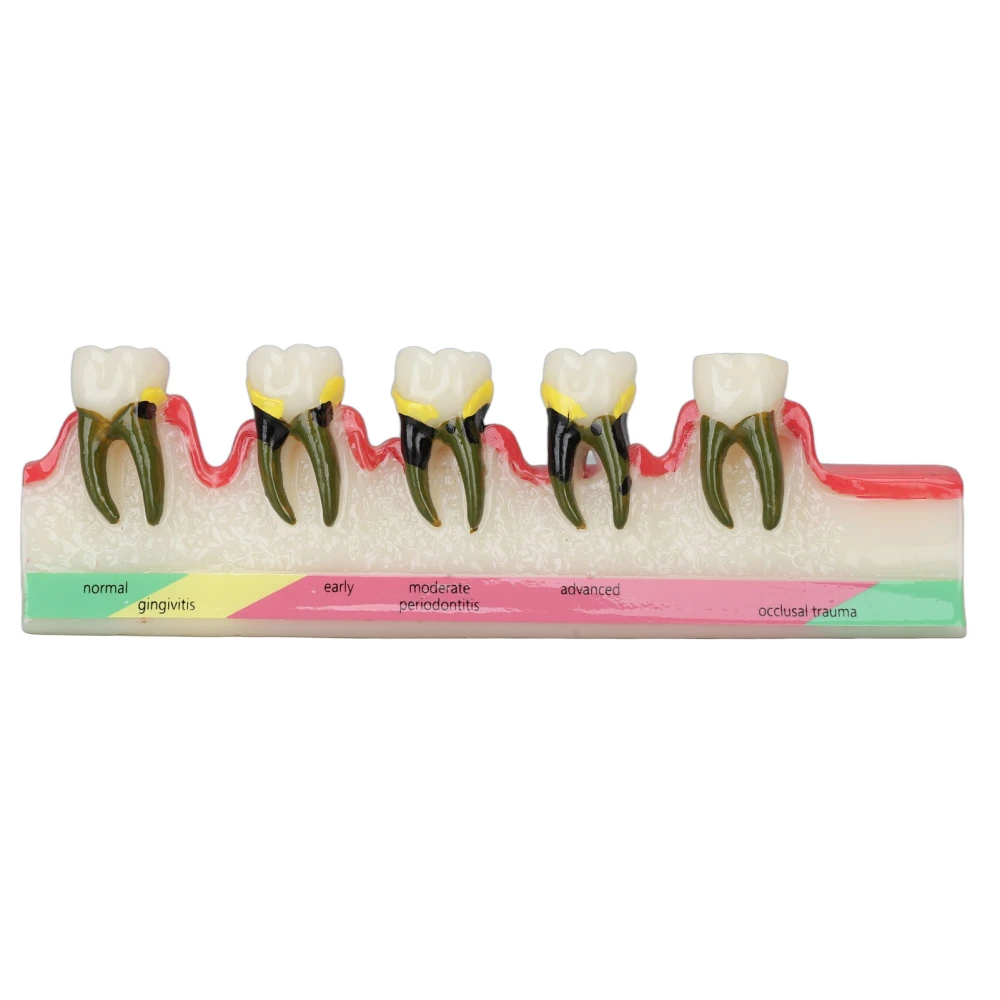 Dental Teeth Model Ceramic Clear Structure Oral Care Educational Periodontal Disease Model