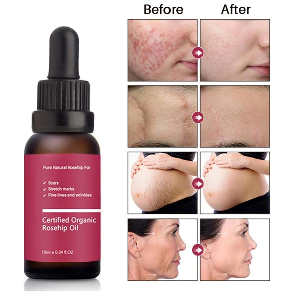 10ml/Bottle Rosehip Seed Oil Cold Pressed Rosehip Oil Moisturizer for Face Dry Skin Fine Lines and Acne Scars