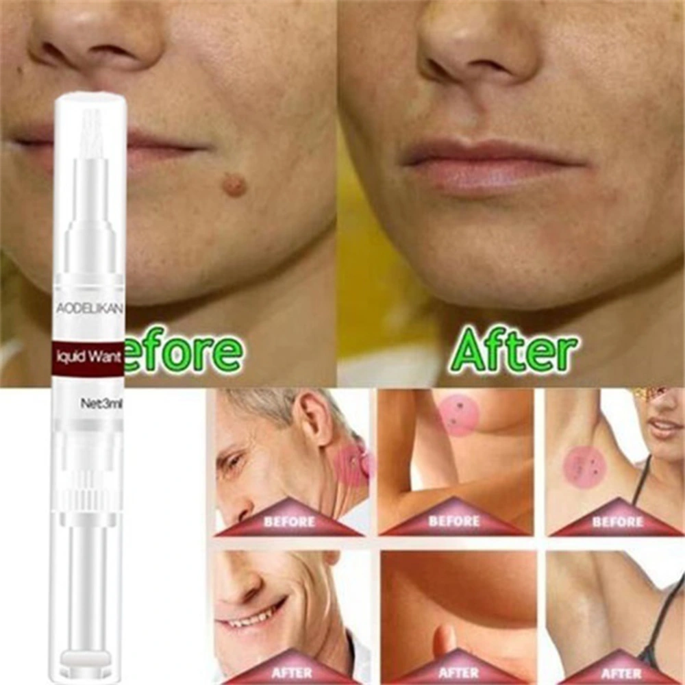 3ml Skin Tags Remover Skin Tag Mole Wart Remover Liquid