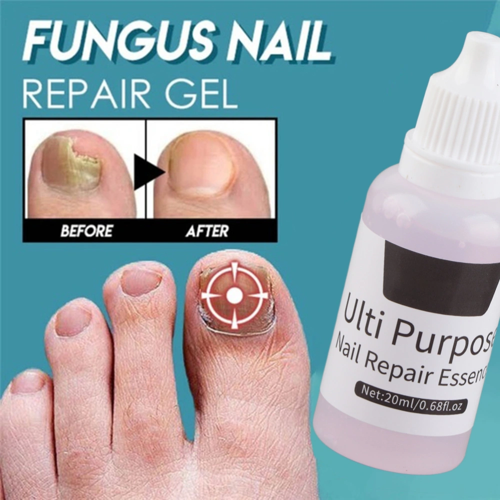 10ml Nail Fungus Liquid Onychomycosis Paronychia Anti Fungal Nail Care Liquid