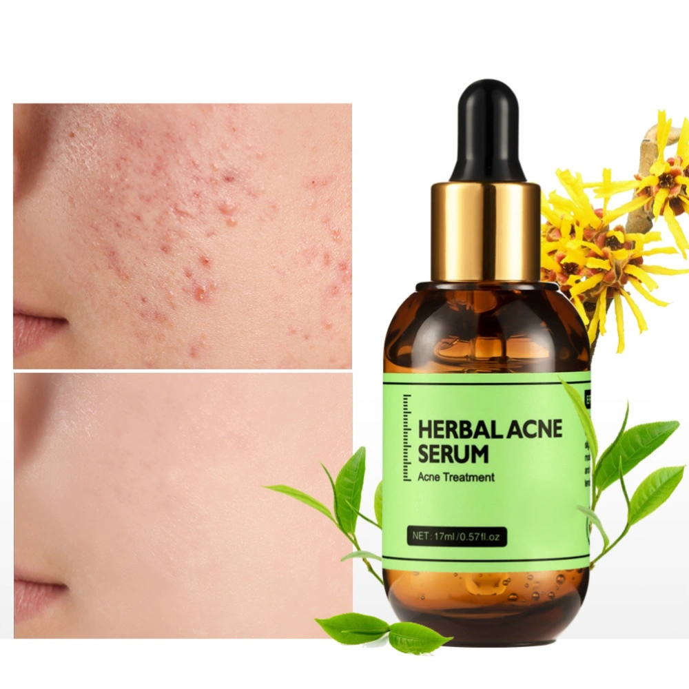 17ML Anti Acne Serum Control Oil and Reduce Acne Marks Herbal Acne Serum for Adults