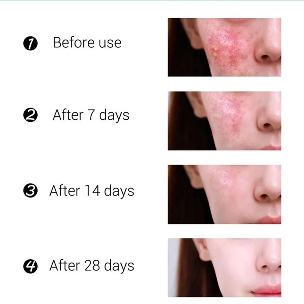 Acne Removal Cream Oil Control Acne Fade Acne Spots Shrink Pores Whitening Moisturizing Acne Cream Skin Care