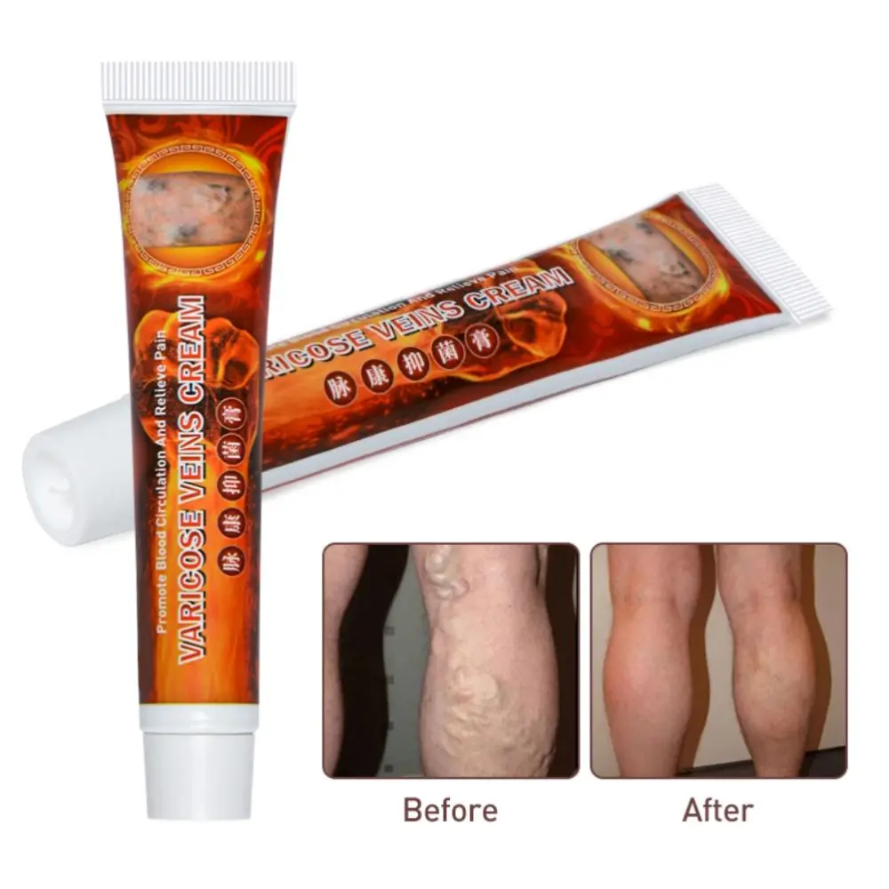 Varicose Veins Treatment Cream Varicose Vein Eliminating Cream Pain Relief Leg Care Cream