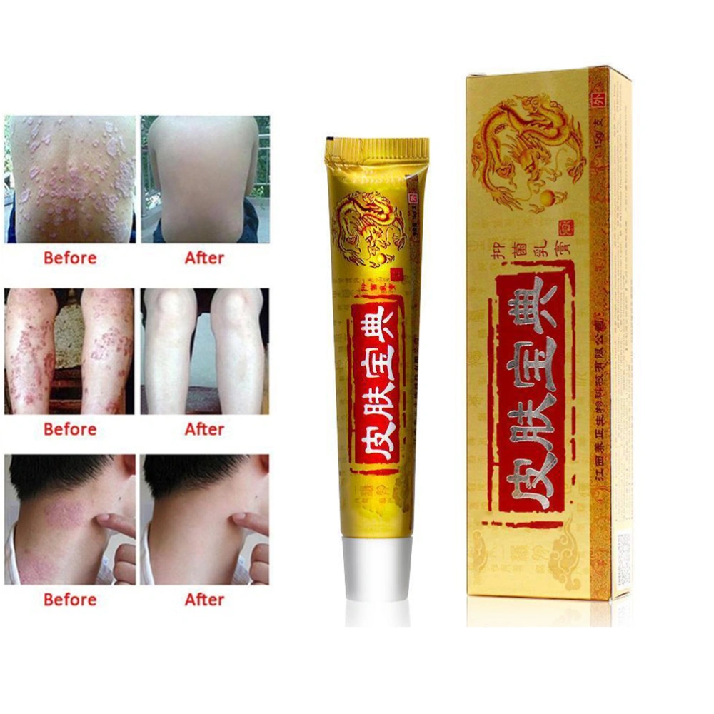 Chinese Medicine Cream Psoriasis Dermatitis Eczema Pruritus Skin Problems Relieve Skin Itching Ointment