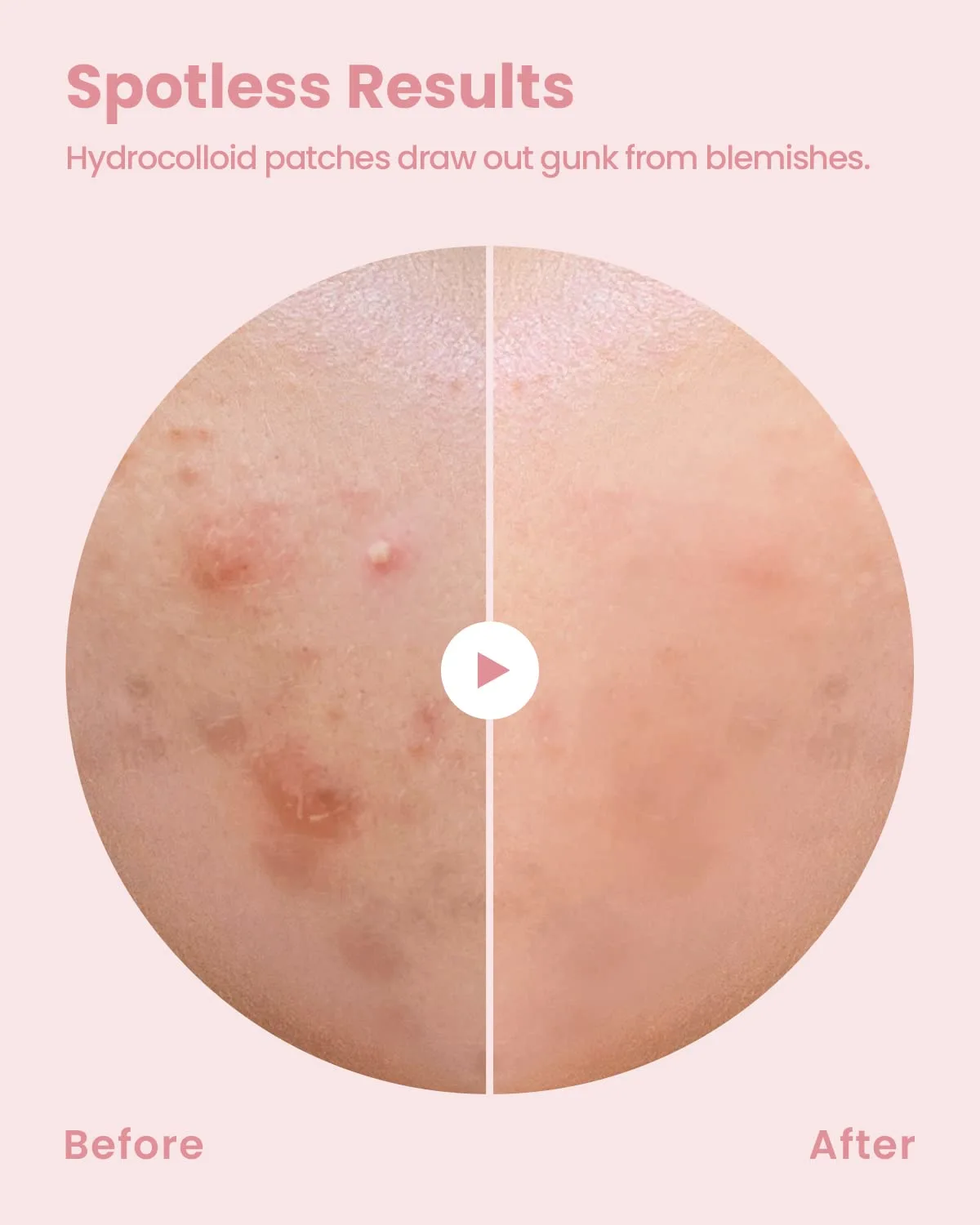GLAM UP Hydrocolloid Blemish Pimple Zit Patches - Invisible Ultra Thin Spot Cover Stickers for Face and Skin, Strong Water-proof and Adhesive Overnight Thin & Invisible (72 Count / 2 Sizes)