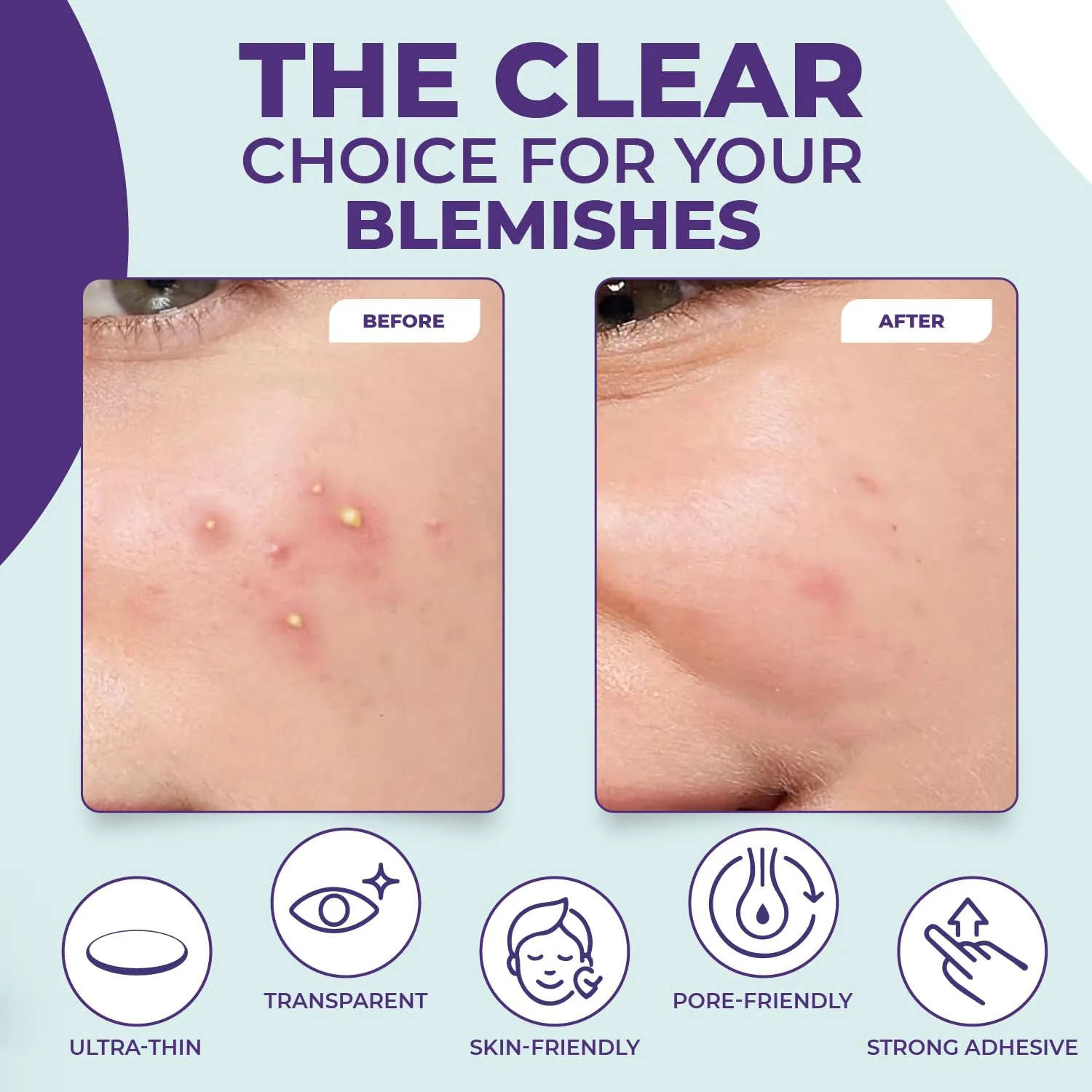 Pimple Patches for face and body | 36 Count (12mm), Invisible Hydrocolloid Acne patches – Face Stickers for Zits, dark spot , Blemishes, Pore strips, Forehead pimple patch , Invisible spot cover