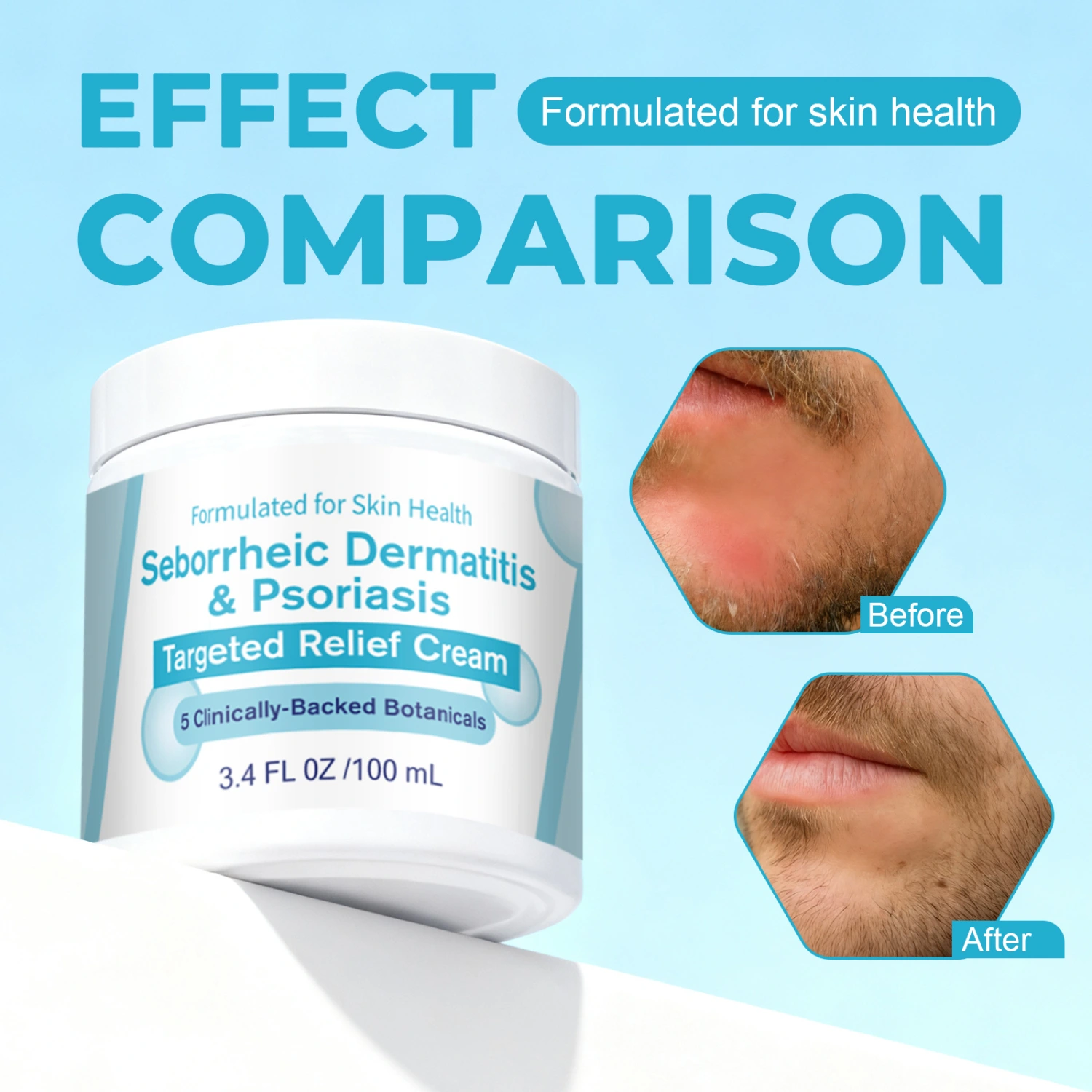 New Seborrheic Dermatitis Cream A Moisturizing Skincare Cream That Nourishes And Soothes The Skin