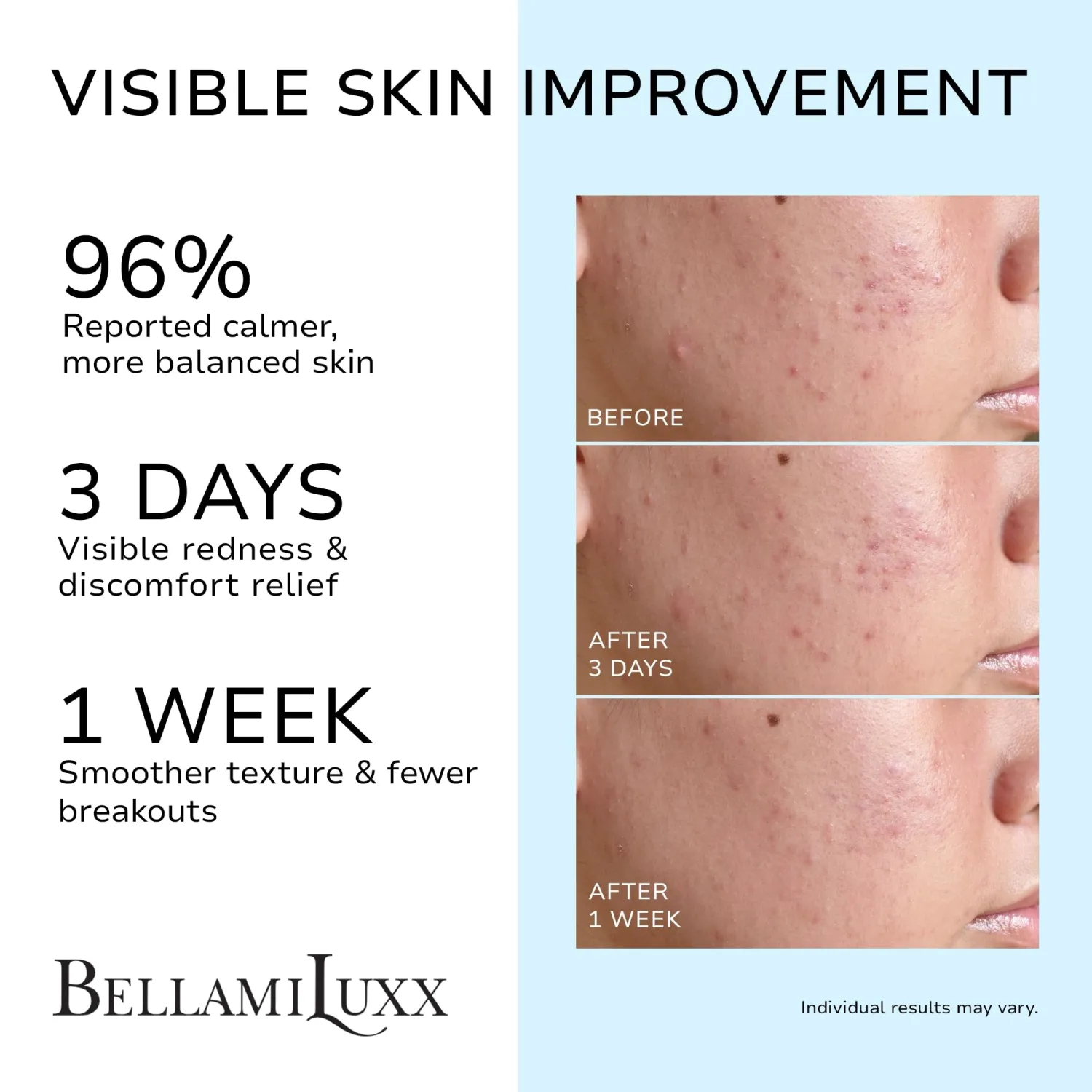 BellamiLuxx Cystic Acne Treatment for Face: Hormonal Acne Treatment Cream for Teens & Adults - Salicylic Acid & Tea Tree Oil Pimple Spot Remover - Anti-Acne Moisturizer Reduces Redness, Blemishes