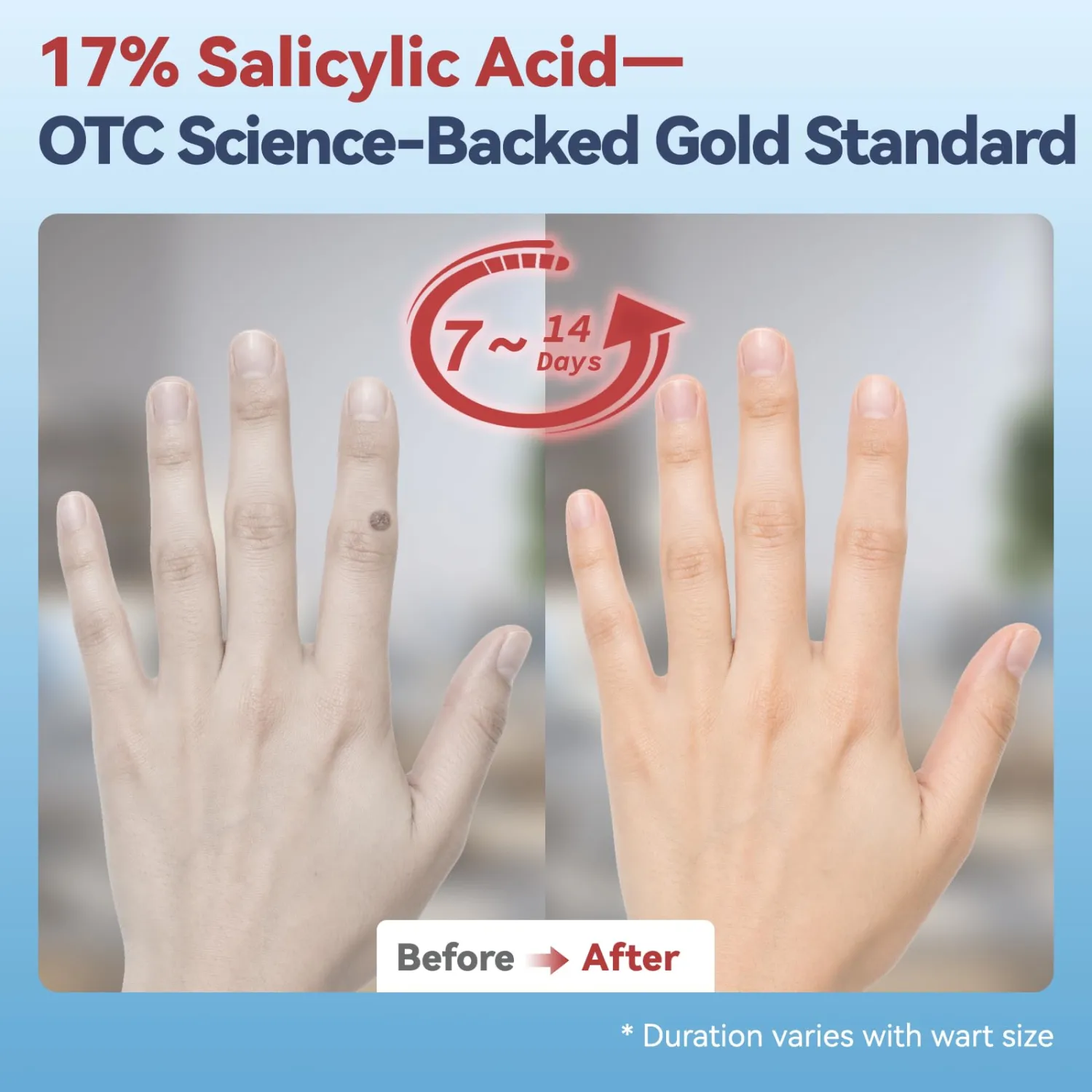 17% Salicylic Acid Wart Remover – Gentle OTC with Natural Plant Extracts, Fast-Acting Effectively Removes for Common Warts and Plantar Warts with Precision applicator & 12 Waterproof Patches