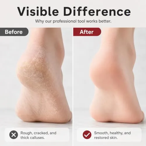 Dual‑Sided Foot Callus Remover, Foot File Callus Remover, Red*2
